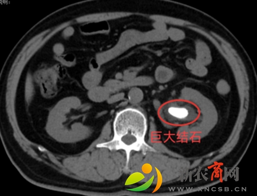 左肾巨大结石患者CT影像.jpg