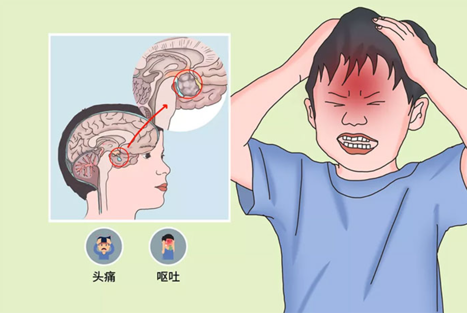 颅咽管瘤
