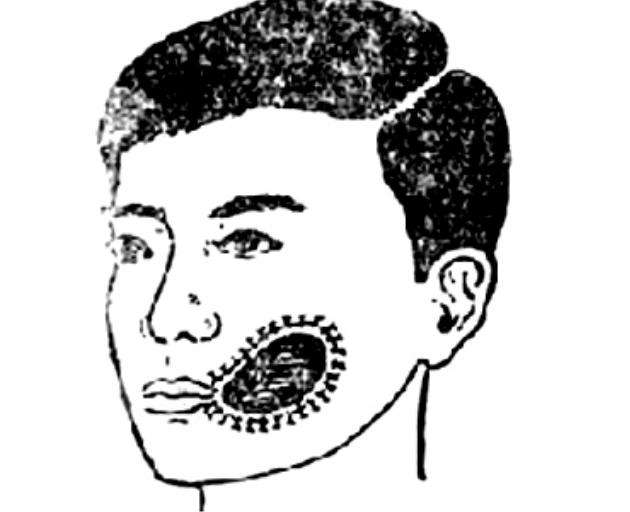 口腔颌面部囊肿