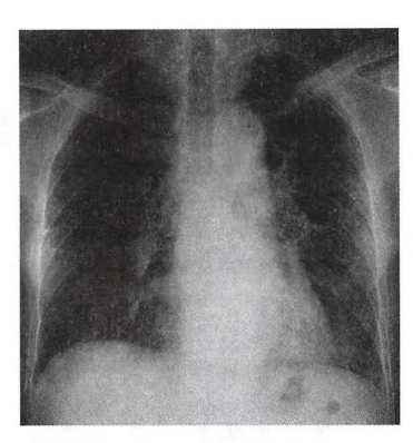 特发性肺纤维化