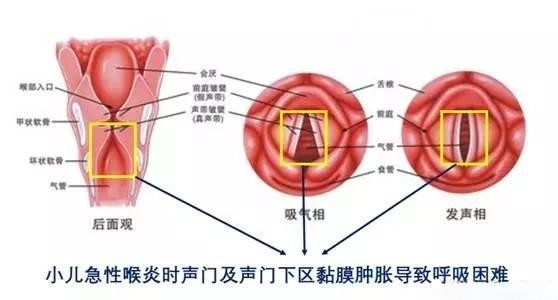 急性喉炎