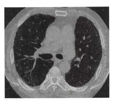 特发性肺纤维化