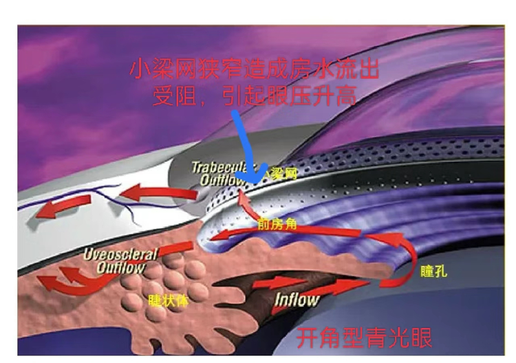青光眼