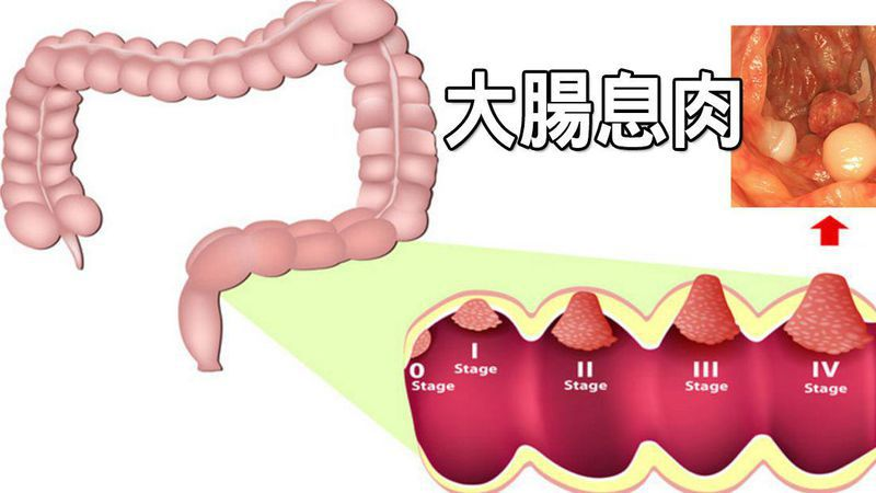 大肠息肉