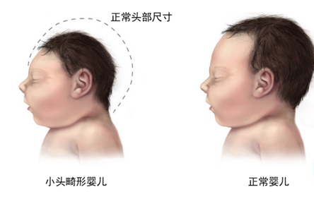 寨卡病毒病