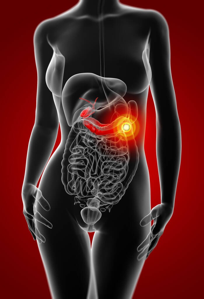 急性胰腺炎