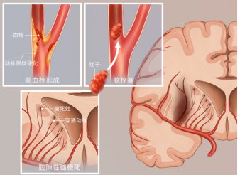 脑梗死