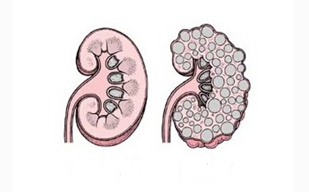 多囊肾