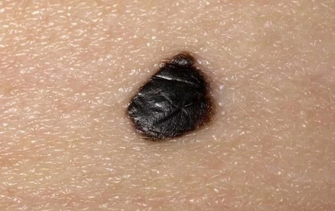 皮肤基底细胞癌