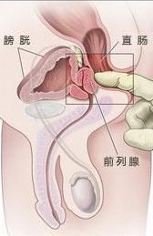 肛门周围癌