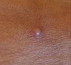 monkeypox-rash01-uk-health-sec-agency-sized_zh (1).jpeg