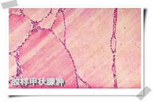 产后甲状腺炎