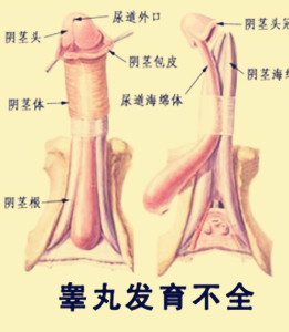 先天性睾丸发育不全