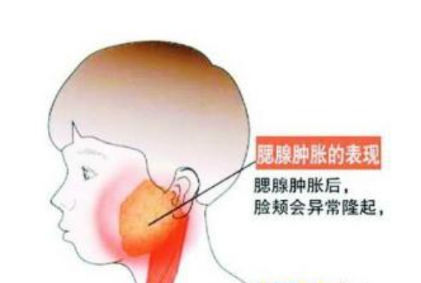 腮腺肿胀