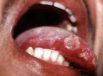 贝赫切特综合征（白塞病）