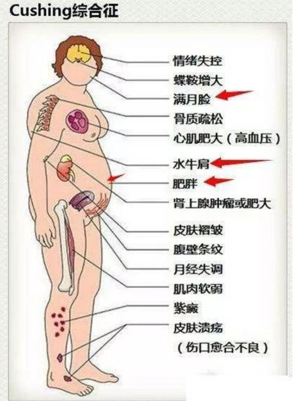 库欣综合征