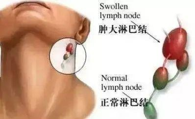 淋巴结肿大