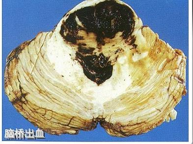 脑桥出血