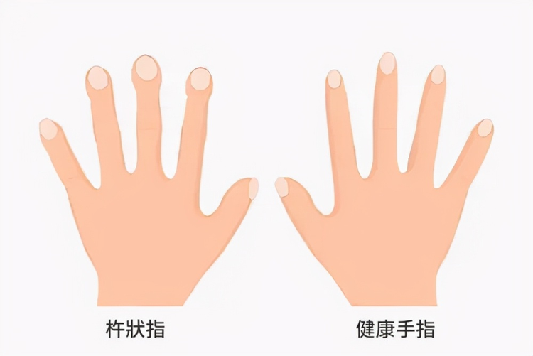 特发性肺纤维化