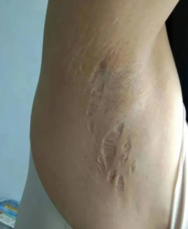 山东女子遭前夫注射激素致残案
