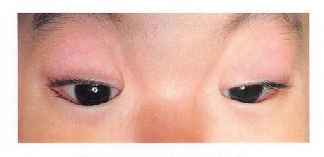 眼睑