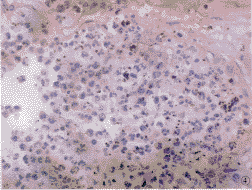 类肺炎性胸腔积液