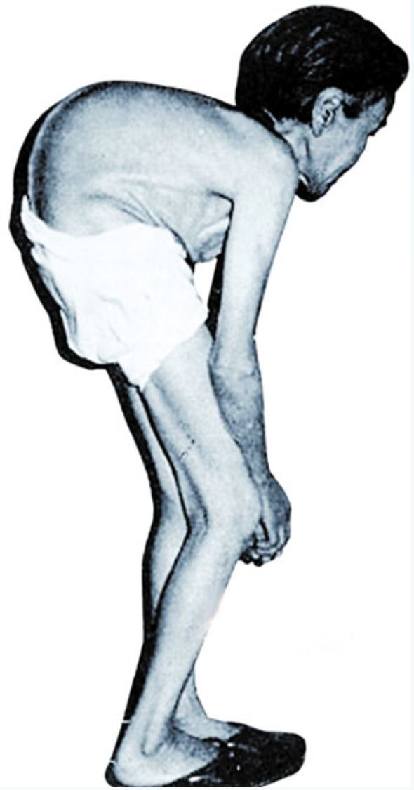 骨痛病患者.png