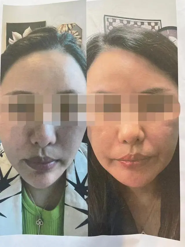 长沙女子花费20万整容失败事件