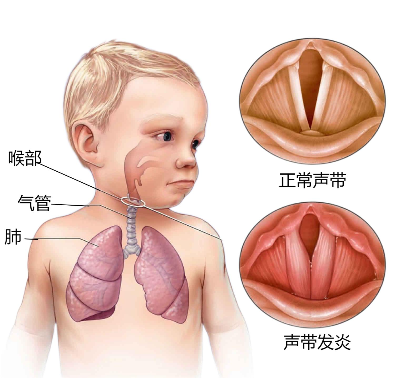 急性喉炎