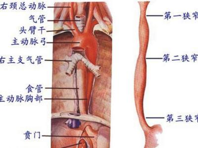 食管贲门黏膜撕裂综合征