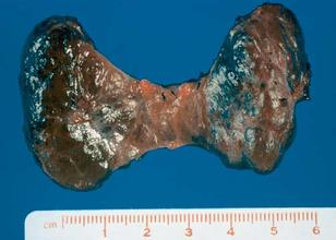 毒性弥漫性甲状腺肿