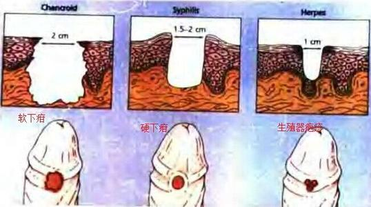 生殖器溃疡