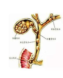 肝胆管结石