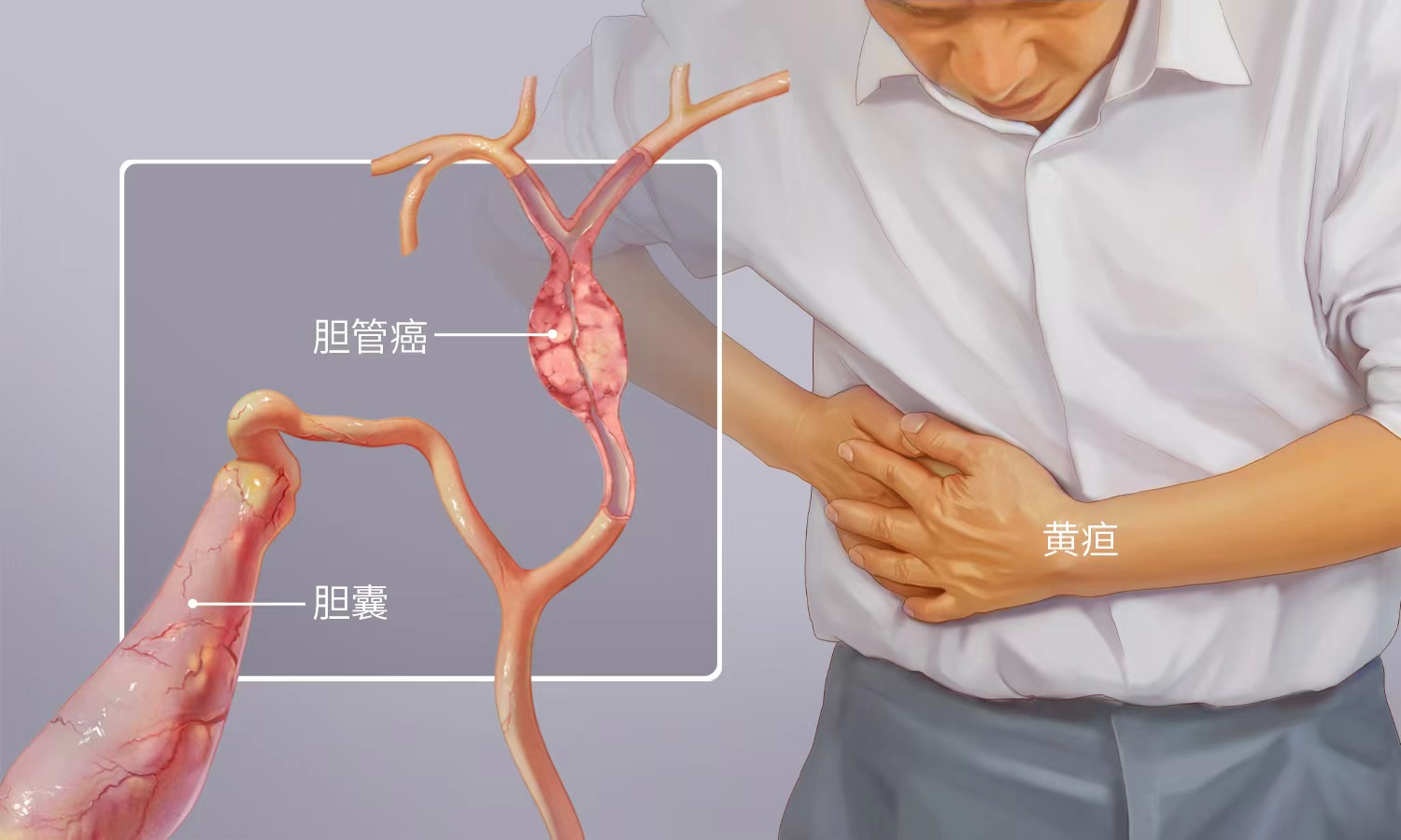胆管癌