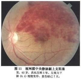 视网膜分支静脉阻塞