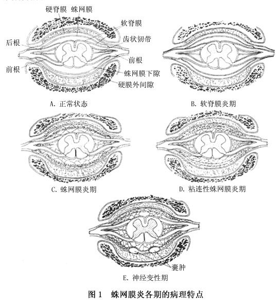 继发性粘连性蛛网膜炎