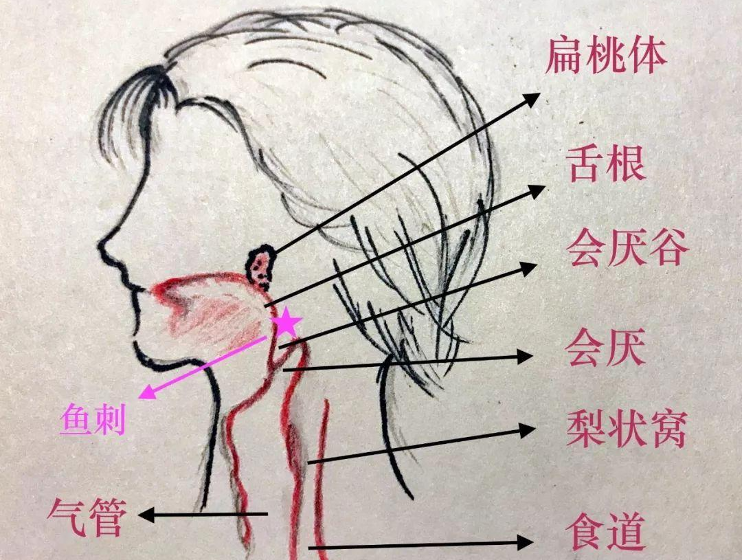 梨状窝癌