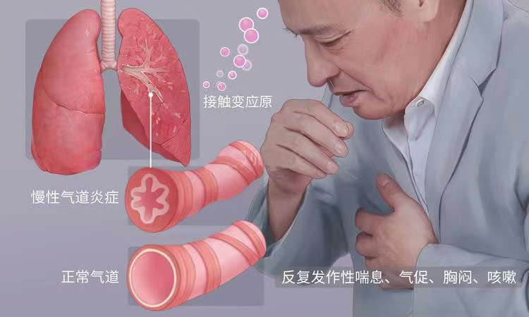 过敏性哮喘
