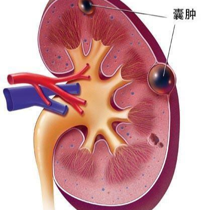 肾囊肿