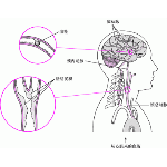 脑卒中