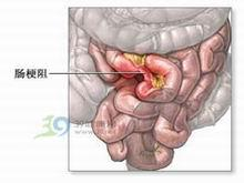 小儿动力性肠梗阻