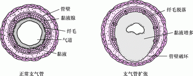 支气管炎