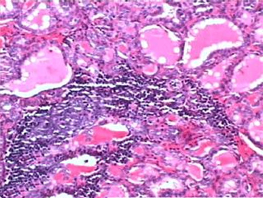 弥散性淋巴组织