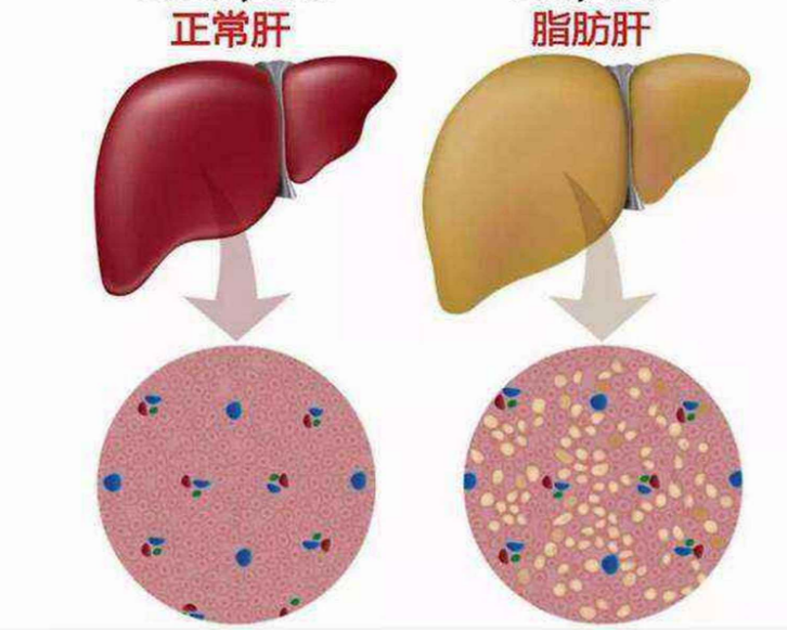 脂肪性肝病