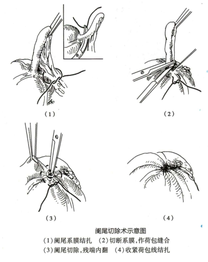 阑尾炎