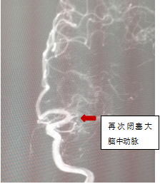 反复狭窄闭塞.jpg
