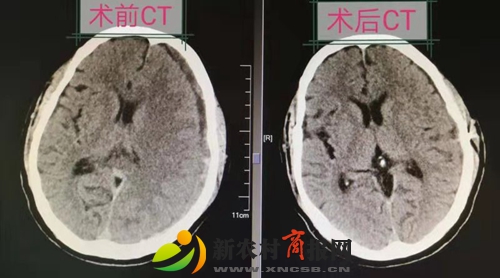 胶州市人民医院采用内镜技术与“锁孔”结合成功治疗复杂慢性硬膜下血肿