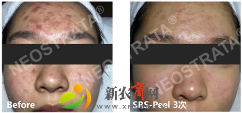 额头重度痤疮明显消红消肿，肌肤愈合，肤色回复正常，毛孔缩小、肤质细腻.jpg