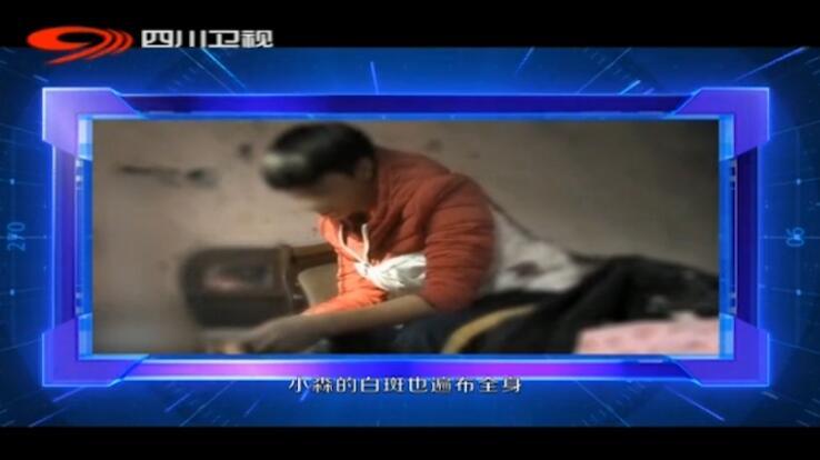 北京国丹白癜风医院王家怀做客四川卫视《特需专家号》