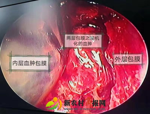 胶州市人民医院采用内镜技术与“锁孔”结合成功治疗复杂慢性硬膜下血肿